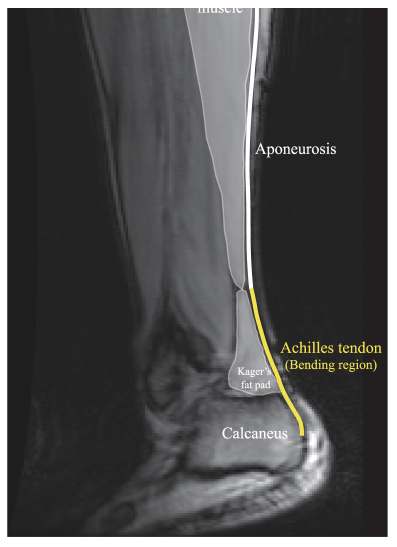 MRI of Achilles tendon