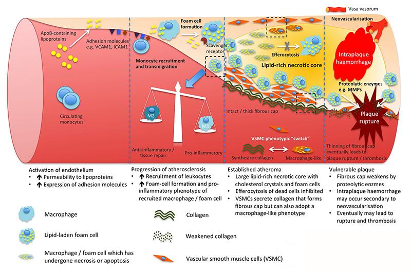 Atherosclerosis Atherosclerosis drawing showing cellular accumulation and lipid rich necrotic core
