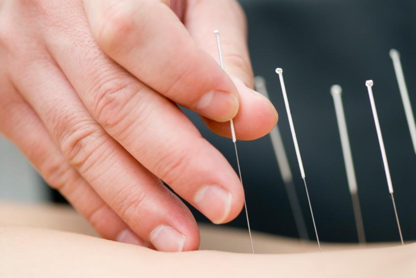 Acupuncture Acupuncture needle in the back