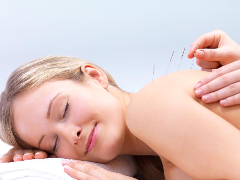 Female patient having acupuncture dry needling treatment Female patient having acupuncture dry needling treatment